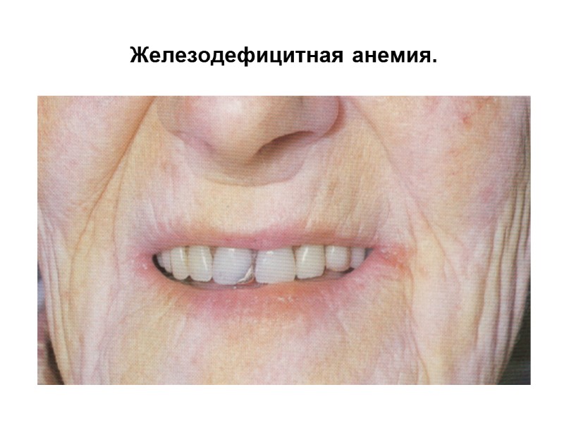 Железодефицитная анемия.